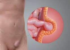 Bỗng một ngày bạn thấy một khối lạ nổi lên ở bụng, bẹn hay rốn? Đó có thể là dấu hiệu của “thoát vị ống tiêu hóa” - một tình trạng khá phổ biến nhưng không nên chủ quan. Bài viết này giải thích đơn giản, dễ hiểu nhất về thoát vị ống tiêu hóa, giúp bạn nhận biết sớm, phòng ngừa đúng cách và biết khi nào cần điều trị gấp!